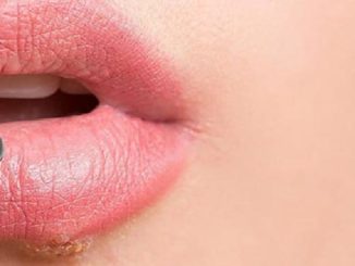 Bläschen an der Lippe das kann Lippenherpes sein! ©Herpotherm