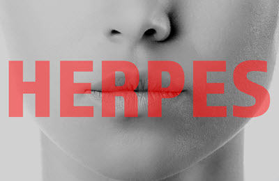 Herpes vorbeugen Lippenherpes richtige Mittel Hausmittel und Cremes gegen Herpesbläschen