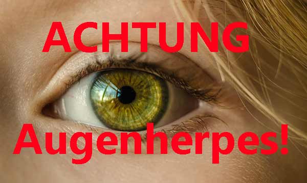 Augenherpes Verwechslung mit harmlosen Augenkrankheiten möglich Info von Dr. Nagy
